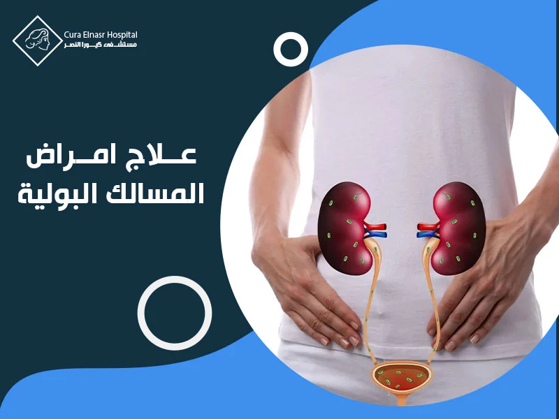 علاج-امراض-المسالك-البولية.webp