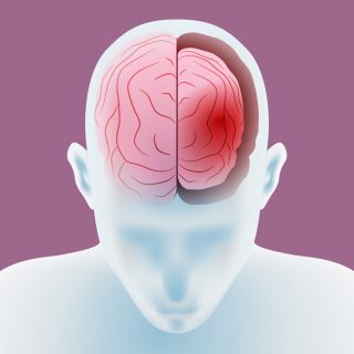 ضمور المخ عند الأطفال 
